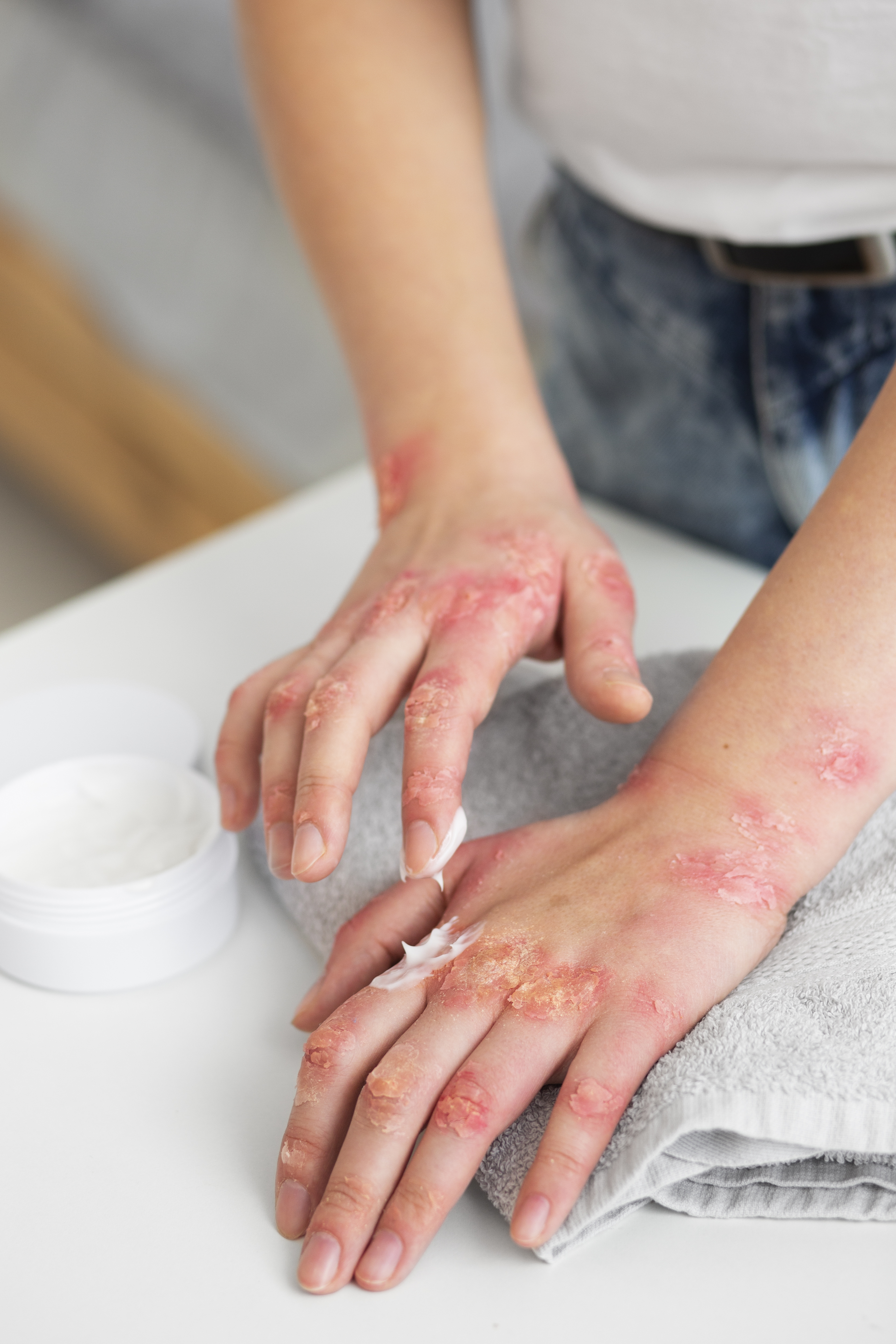 Man som smörjer sin plackpsoriasis på handen med kräm