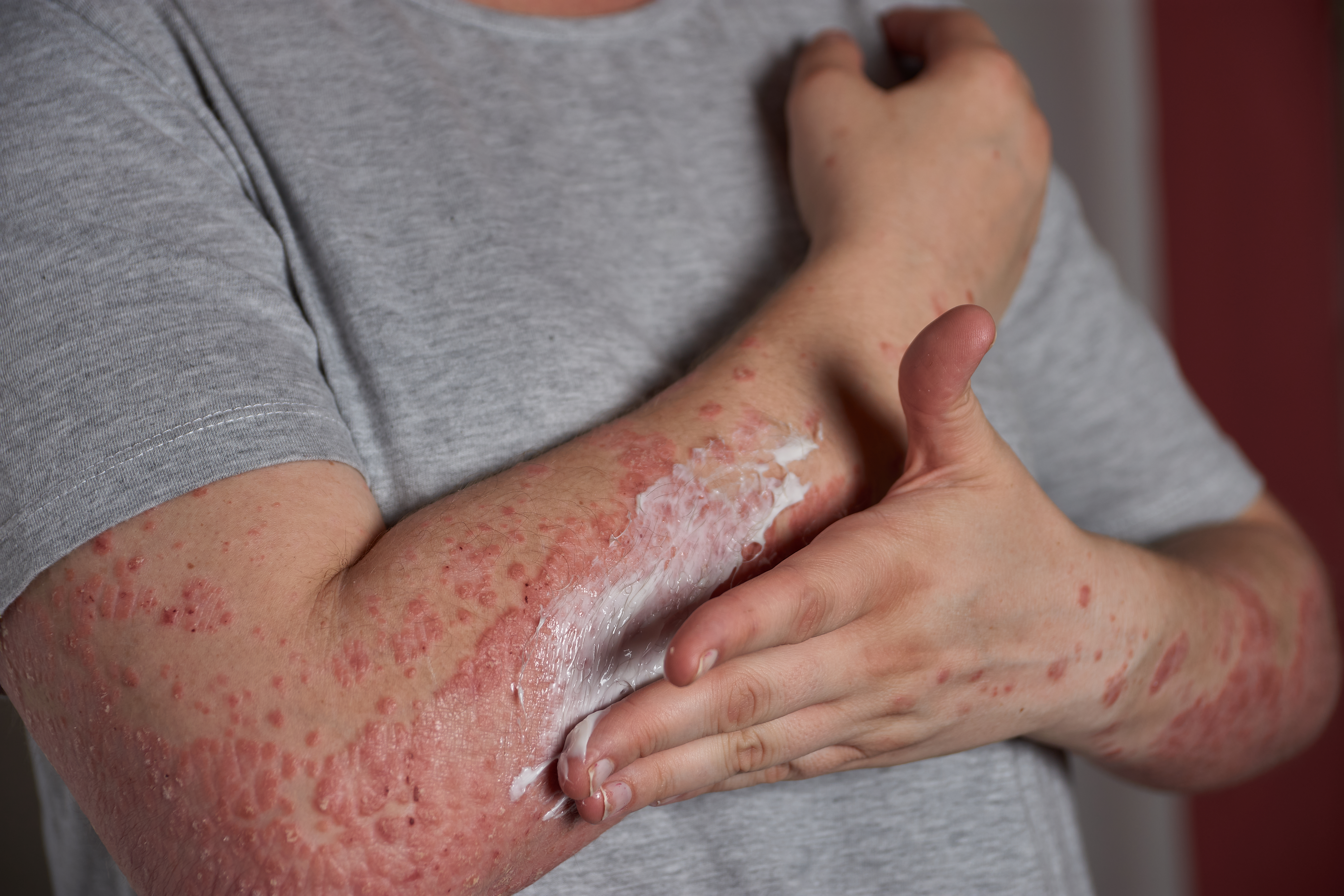 man smörjer sin guttat psoriasis med mjukgörande kräm