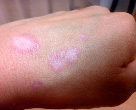 Vitiligo - vita fläckar - i stället för bruna pigmentfläckar?... 7 September 2013