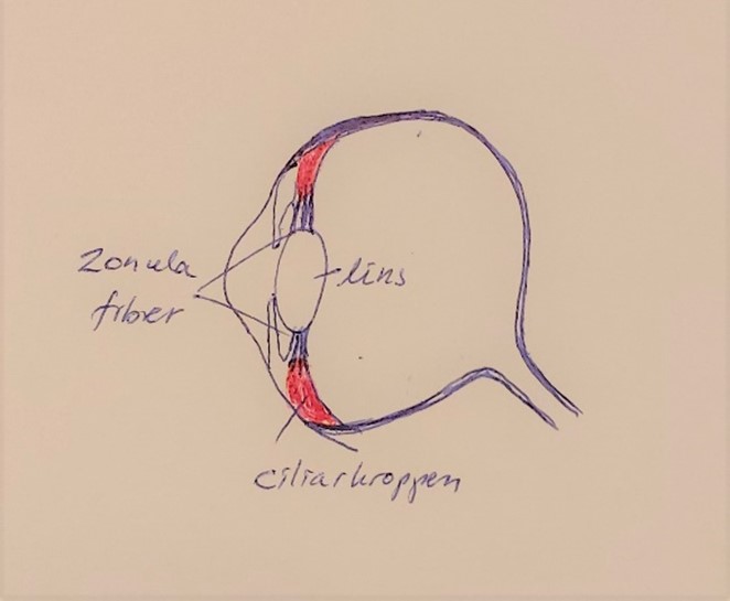 Det normala ögats lins är upphängd i zonulatrådar som fäster runtom linsen och i ciliarmuskeln . Vid PLL bryts zonulatrådarna som håller linsen på plats ned.